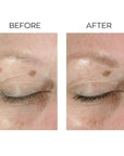 Anew lifting dual eye system