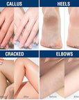 OUKEYA Urea Cream 40 Percent, Foot & Hand Cream for Dry Cracked, Urea Lotion for Feet Maximum Strength(12.35Oz X 2 Packs)