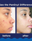 PanOxyl Acne Foaming Wash Benzoyl Peroxide 10% Maximum Strength Antimicrobial, 5.5 Oz