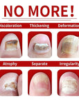 Ginger Nail Treatment, Nail Treatment,