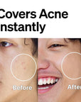 FRONTMAN Fade, Men's Acne Concealer With Salicylic Ac