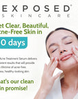 Exposed Skin Care Acne Treatment Serum