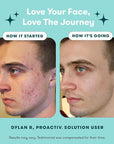 Proactiv 3 Step Acne Treatment - Benzoyl Peroxide Face Wash, Repairing Acne Spot Treatment for Face and Body, Exfoliating Toner - 30 Day Complete Acne Skin Care Kit