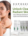 Exposed Skin Care Expanded Acne Treatment Clearing