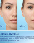 Differin acne treatment gel, 90