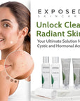 Exposed Skin Care Basic Acne Treatment Clearing