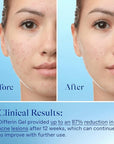 Differin acne treatment gel, 60