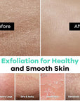 Dermasuri - Deep Exfoliating Glove - Korean Exfoliating Mitt - Body Scrubber for Shower - Buffs Dry & Dead Skin - Keratosis Pilaris Treatment Scrub - Stocking Stuffer Gifts for Women & Men - Teal Mitt