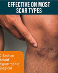 Scar Sheets Light Tone 4 Pack