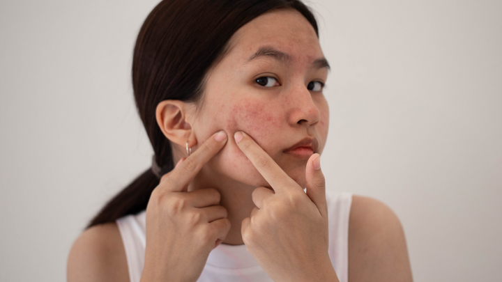 Top 5 Best Ingredients for Acne-Prone Skin: What Really Works?