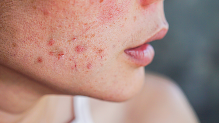 The Best K-Beauty Ingredients for Acne-Prone Skin