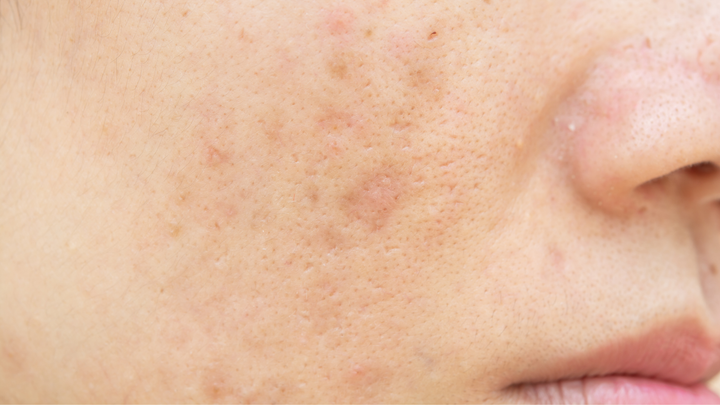 What Really Causes Dark Spots and How to Prevent Them Before They Appear