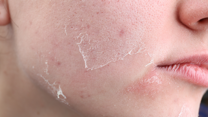 How to Treat Dry and Dehydrated Skin with K-Beauty Products