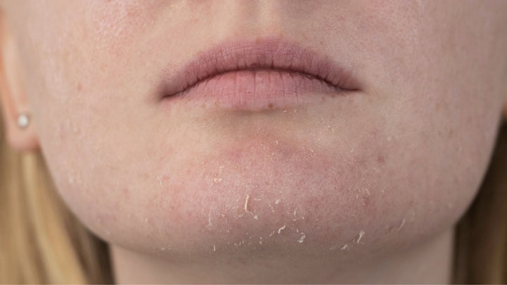 Sensitive Skin vs Sensitized Skin: How to Tell the Difference and Treat Each One