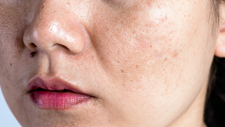 How to Treat Hyperpigmentation with Korean Skincare Ingredients