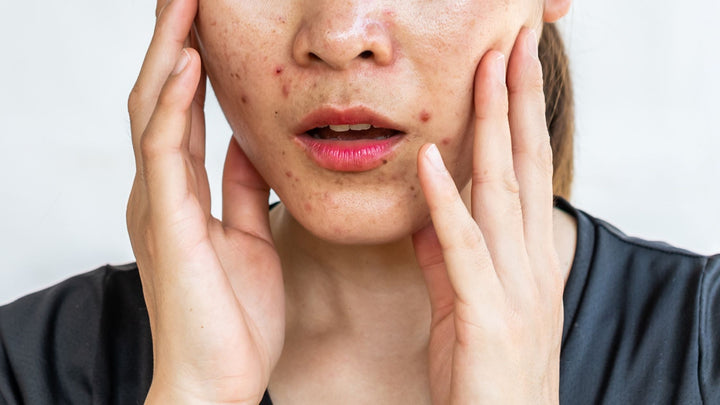 Dark Spots: Causes, Prevention, and K-Beauty Solutions