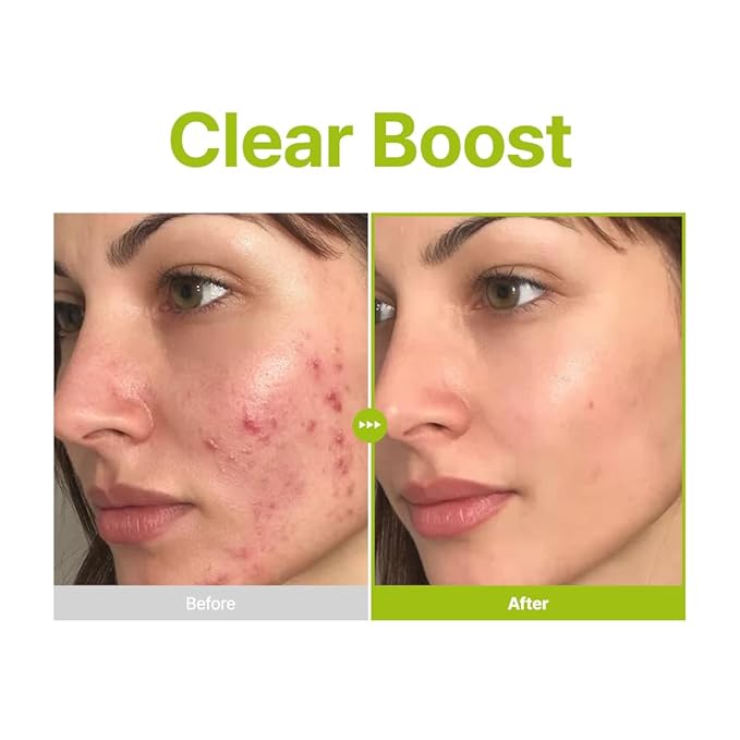 PURITO Azelaic Acid 10% + Kojic Acid + Tea Tree Facial Serum | for Acne & Marks, Breakouts | High-Level Azelaic Acid 10% | Korean skincare, 30mL 1.01 fl.oz