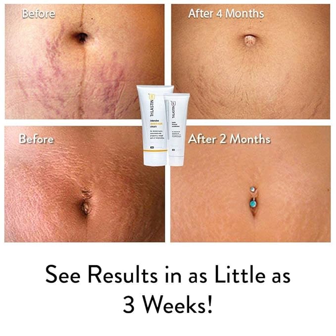 TriLASTIN-SR Intensive Stretch Mark Cream Bundle Fast-Acting