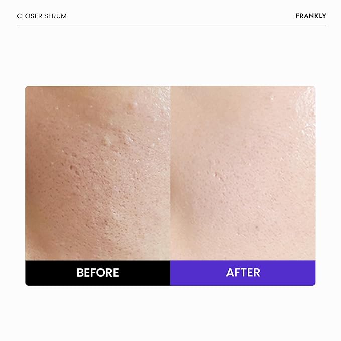 FRANKLY Pore Perfecting Set : Closer Serum, Toner Pads & Cleansing Oil | Deep Cleansing, Hydration, Pore Refining | For Sensitive, Oily & Acne-Prone Skin | Vegan & Fragrance-Free| Korean Skincare set