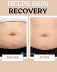Stretch Mark Cream for Sensitive Skin Plant-Based Long and Short-term Hydration, Increases Skin Elasticity and Firmness (Stretch Mark Cream)
