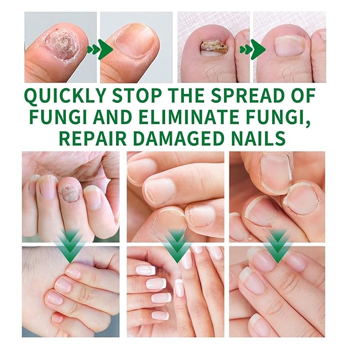 Ginger Nail Treatment, Nail Treatment,