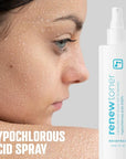 BRIOTECH Skin Renew Toner, Hypochlorous Acid Spray Topical Skin Spray for Face and Skin, Minimize Appearance of Blemishes, Soothing Mist for Redness & Bumps, 4 fl oz ea, 4 ct
