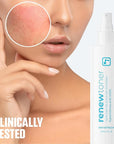 BRIOTECH Skin Renew Toner, Hypochlorous Acid Spray Topical Skin Spray for Face and Skin, Minimize Appearance of Blemishes, Soothing Mist for Redness & Bumps, 4 fl oz ea, 4 ct