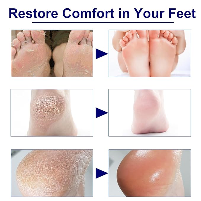 Urea Cream 40 Percent for Feet Maximum Strength – Foot Callus Remover Cream Plus 2% Salicylic Acid for Dry, Cracked Heels and Feet Repair, 3.4 oz