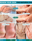 Urea Cream 40 Percent For Feet Maximum Strength - plus Salicylic Acid 2% Foot Cream For Dry Cracked Heels Feet Knees - Dead Skin Cuticle Callus Remover Toenail Softener - Pack of 2