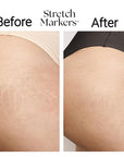 StretchMarkers Therapy Visibly Reduce and Treat Stretch Marks Cream, 1 fl oz, Retinol, Hyaluronic Acid, Bioactive Peptides & 3D Stem Cell Technology