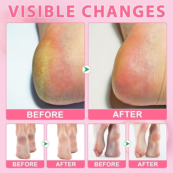Urea Cream Stick 60% plus Salicylic Acid 2%, Maximum Strength Urea Foot Cream for Dry Cracked Feet, Knees, Elbows, Hands, Exfoliating Dead Skin, Softening Skin (1 PC Peach Scent, 40G)