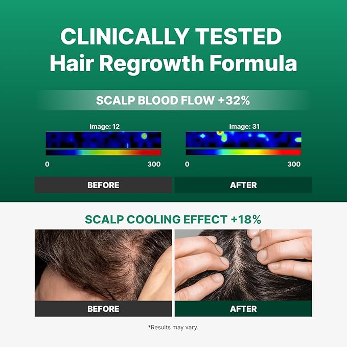 Spicule Microneedling Exosome Hair Growth Serum, Hair Loss Treatments for Women and Men, Peppermint Oil Cooling Scalp Serum, Menthol, Korean Hair Care (0.5 fl oz / 15ml)