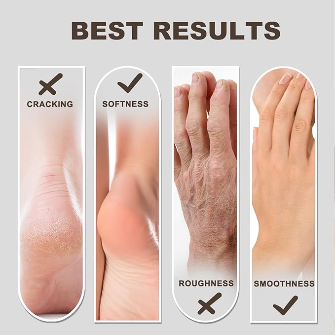60% Urea Foot & Hand Cream with 2% Salicylic Acid - Intensive Moisturizer for Dry, Cracked Heels, Feet, Elbows, Hands and Knees - Callus Remover lotion with Jojoba Oil, Avocado Oil & Aloe Vera, 7 oz