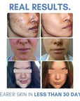 Clarifying Toner for Acne and Blemishes,