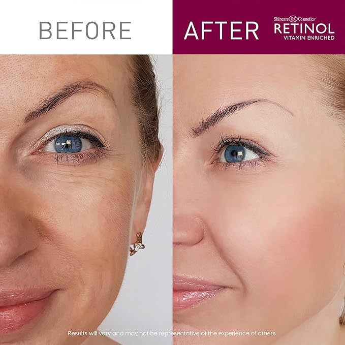 Retinol Cream Cleanser Anti-Aging – 5oz – Daily Deep Cleansing Facial Wash Improves Skin Texture, Moisturizes, And Exfoliates for Softer Face – Renewing Vitamin A Minimizes Wrinkles and Fine Lines