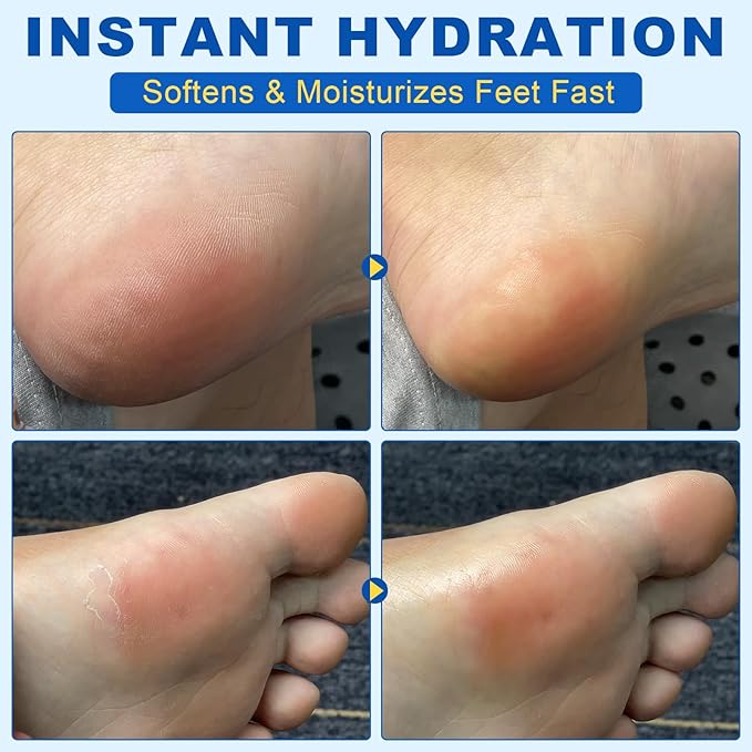 Urea Cream Stick 60% plus Salicylic Acid 2%, Maximum Strength Urea Foot Cream for Dry Cracked Feet, Knees, Elbows, Hands, Exfoliating Dead Skin, Softening Skin Moisturizer (1PC, 40G)