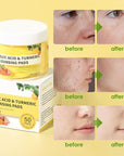 Turmeric kojic acid cleansing pads