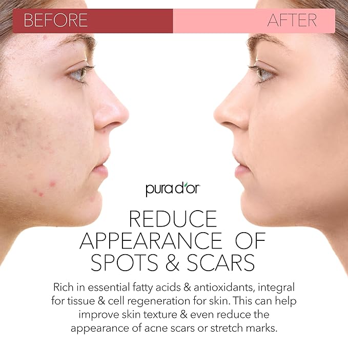 PURA D'OR ORGANIC Rosehip Seed Oil Hair Relaxer (4 Oz x2 = 8 Oz) 100% Pure Cold Pressed USDA Certified All Natural Anti-Aging, Scar Treatment, Gua Sha Massage, Face, Hair & Skin - Women & Men