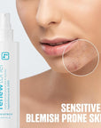 BRIOTECH Skin Renew Toner, Hypochlorous Acid Spray Topical Skin Spray for Face and Skin, Minimize Appearance of Blemishes, Soothing Mist for Redness & Bumps, 4 fl oz ea, 4 ct