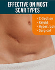 NUVADERMIS Silicone Scar Sheets - Extra