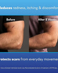 ScarAway Advanced Skincare Silicone Scar Sheets,