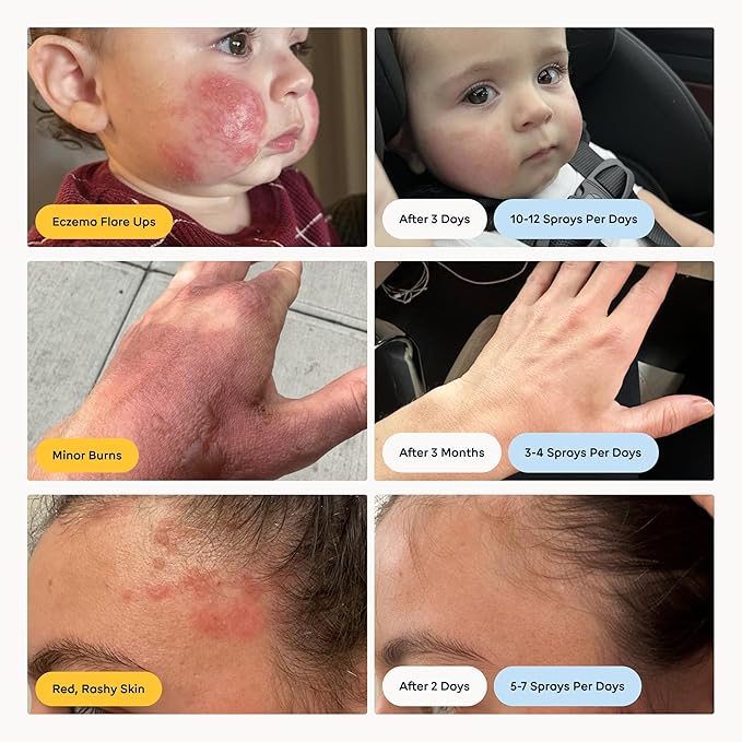 Magic Molecule Skin Cleanser for All Types, Hypochlorous Acid Spray Helps Heal Acne Prone, Eczema and Itchy Rashes and 50 Other Skin Ailments, 8 oz Spray (Pack of 3)