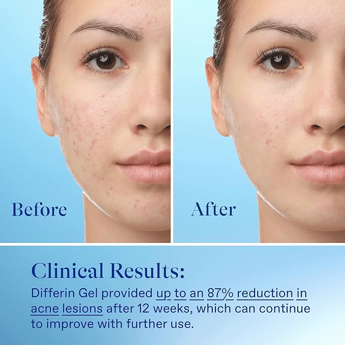 Differin acne treatment gel, 30