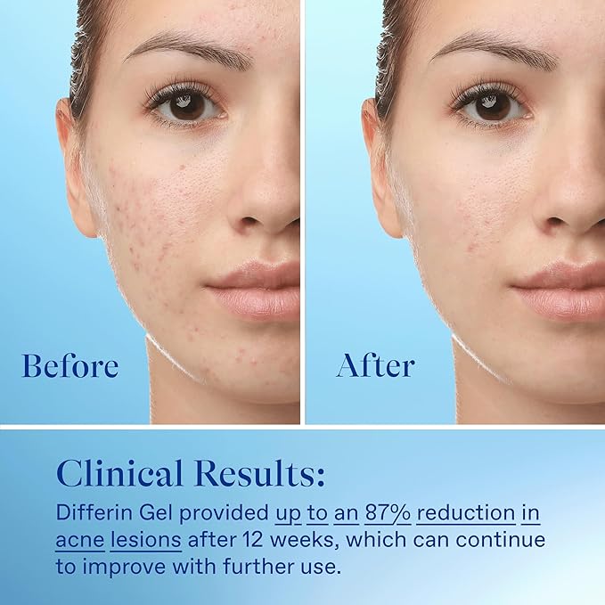 Differin acne treatment gel, 30