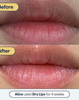 Remedy for Dry Lips - Hydrating and Healing Lip Balm Ointment with Ceramides, Peptides, and Dimethicone - Repairs Dry, Cracked Lips - By Dermatologist Dr. Shah