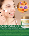 Manuka Honey Eczema Cream Moisturizing Lotion For Psoriasis Relief - Itchy, Dry Skin Rash Ointment -Skin Soothing Moisturizer Baby Kids & Adults-High Strength Body & Face Cream 16oz