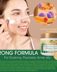 Manuka Honey Eczema Cream Moisturizing Lotion Fragrance Free For Psoriasis Relief - Itchy, Dry Skin Rash Ointment - Skin Soothing Moisturizer - Body & Face Cream - Kids & Adults 2oz