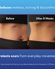 ScarAway Silicone Scar Gel, Helps Improve 20g